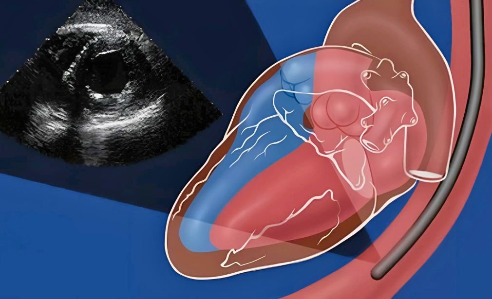 Ecocardiografía Transesofágica